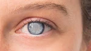 Cataract Surgeries