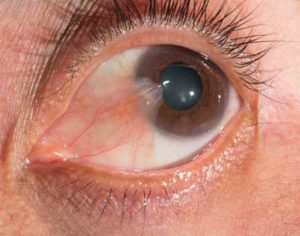 Cornea